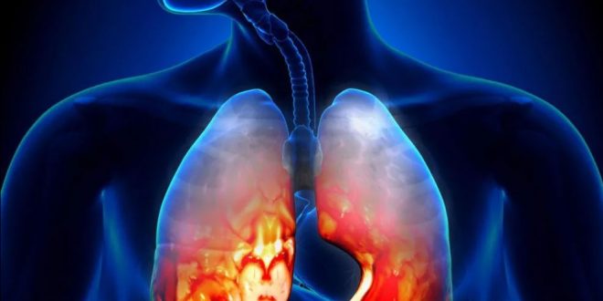 Что такое туберкулезный плеврит и как кортикостероиды могут работать?